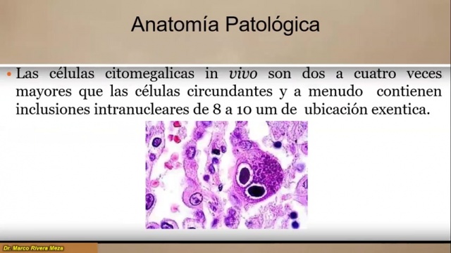 1. Citomegalovirus